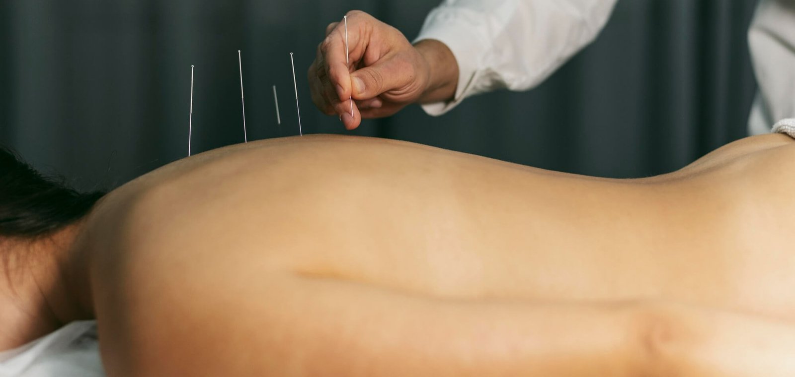 Acupuncture